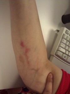 The tracks of my chemo